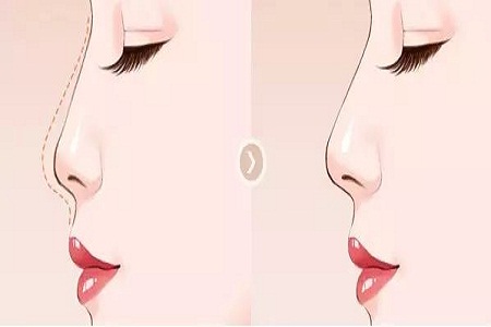 關(guān)于鼻整形修復(fù)，你需要知道的