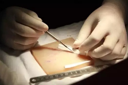 假體隆鼻的“高度”主要決定于哪些因素？