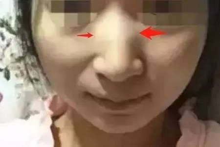 側(cè)面看鼻梁不矮,正面看鼻子卻很塌是什么原因？
