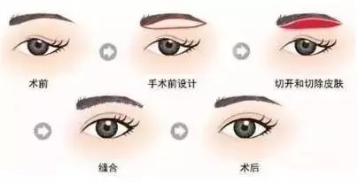 上瞼皮膚松弛——眉下(上)皮膚提升術(shù)