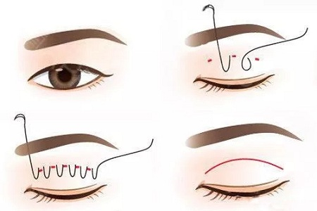 ?雙眼皮手術(shù)只聽過全切？還有哪些眼部手術(shù)方法？