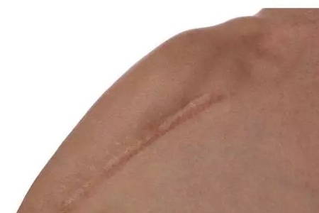 疤痕體質(zhì)不能做整形項(xiàng)目了嗎？