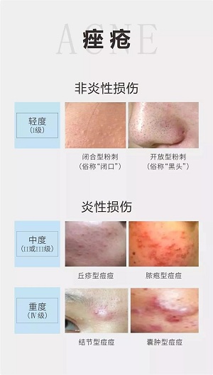 痤瘡分為粉刺和毛囊炎兩大類(lèi),按輕重程度分成四個(gè)等級(jí)