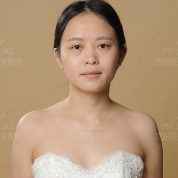 美萊案例趙依依對(duì)比圖后