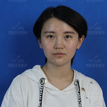 美萊案例李若男對(duì)比圖后