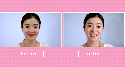 別讓“大黃牙”毀了你的形象，如何變白呢？ 聽王凱院長(zhǎng)解答