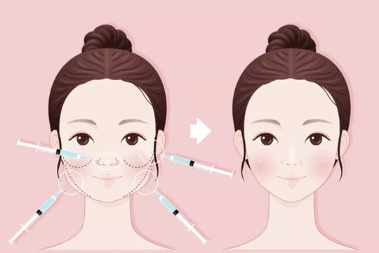 鄭州美萊瘦臉針注射效果好嗎？