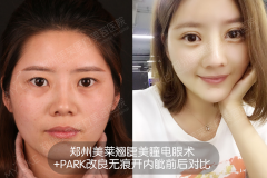 雙眼皮全切好還是埋線好？鄭州美萊割雙眼皮哪位醫(yī)生好？