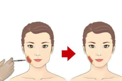 鄭州美萊整形瘦臉效果好嗎？