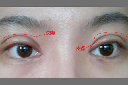 雙眼皮失敗了怎么辦？<a href='/zz/' target='_blank'><u>鄭州美萊</u></a>醫(yī)院助你重獲新生