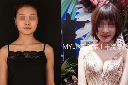 <a href='/zz/' target='_blank'><u>鄭州美萊</u></a>整形假體豐胸和自體豐胸哪個(gè)好?