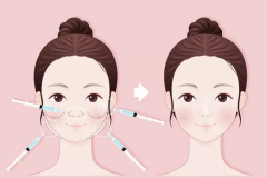鄭州美萊整形瘦臉有副作用嗎？