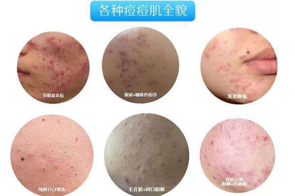 <a href='/zz/' target='_blank'><u>鄭州美萊</u></a> 推出痤瘡光電治療徹底去除痤瘡