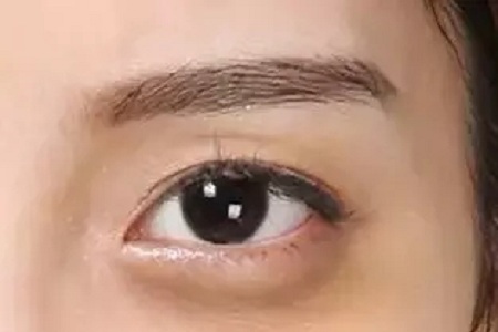 內(nèi)切祛眼袋多久會恢復好