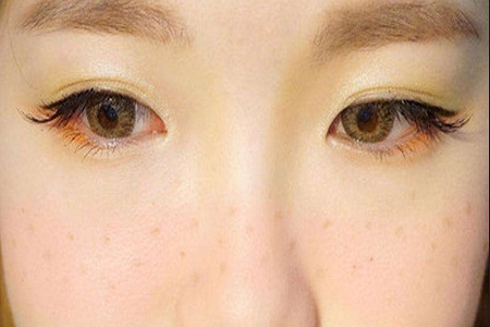 激光祛斑哪家醫(yī)院好