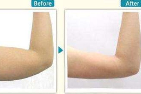 貴陽(yáng)手臂吸脂需要多少錢