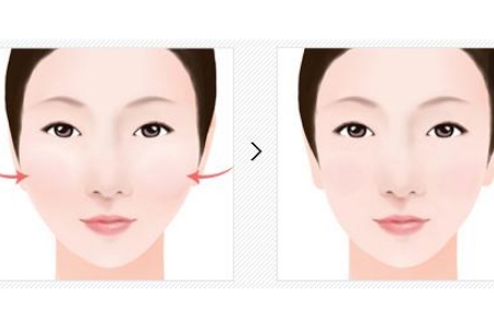 曲靖改臉型多少錢？影響因素有哪些