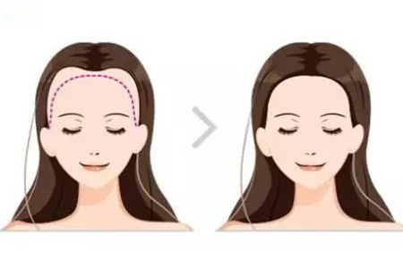 常州發(fā)際線調(diào)整效果好嗎，發(fā)際線如何調(diào)整？
