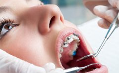 學(xué)生箍牙齒一般多少錢，2023牙齒矯正價格表