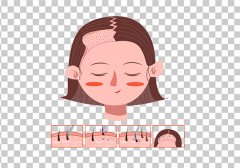 武漢哪家醫(yī)院植發(fā)技術(shù)比較好，效果能保持多久