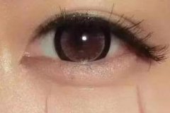 自體脂肪豐臥蠶填幾次有效果，術后注意事項有哪些