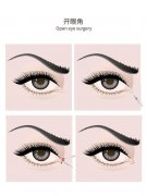 武漢做開眼角手術風險大不大,需要多久恢復自然