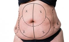 腰部抽脂減肥安全嗎，蘇州、南京、杭州費用表