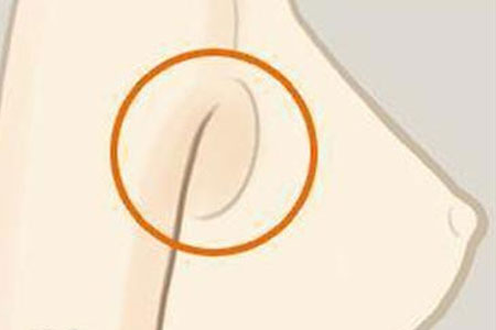 腋下副乳做手術(shù)切除需要多少錢(qián)