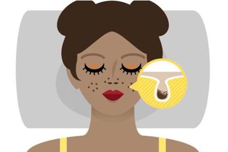 激光收縮毛孔大概多少錢，貴不貴啊