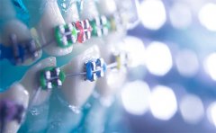 自鎖托槽牙齒矯正多少錢，石家莊、西安、泉州價(jià)格一覽表