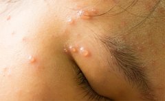 激光去痘印一般要幾次才能好，術(shù)后怎么護(hù)理