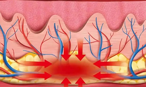 北京美萊&以色列飛頓，限量發(fā)售黃金熱拉提