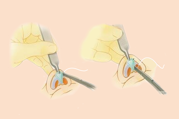 膨體加耳軟骨隆鼻組合效果好嗎？