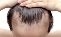 種植發(fā)際線多久能長起來，沈陽、廈門、福州植發(fā)價格一覽表