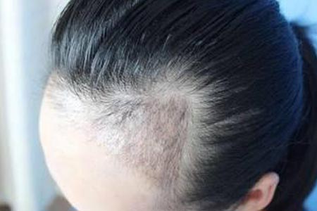 石家莊做發(fā)際線調(diào)整手術價格貴嗎