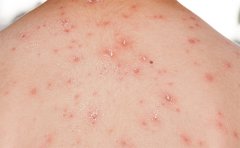 去醫(yī)院祛痘印大概多少錢，重慶、鄭州、武漢價格參考