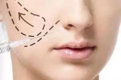 自體脂肪豐蘋果肌大概多少錢，效果怎么樣