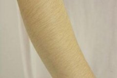 冰點(diǎn)手臂脫毛效果好不好，術(shù)后需要注意什么